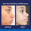 imagePanOxyl Acne Foaming Wash Benzoyl Peroxide 10 Maximum Strength Antimicrobial 55 Oz55 Ounce Pack of 2
